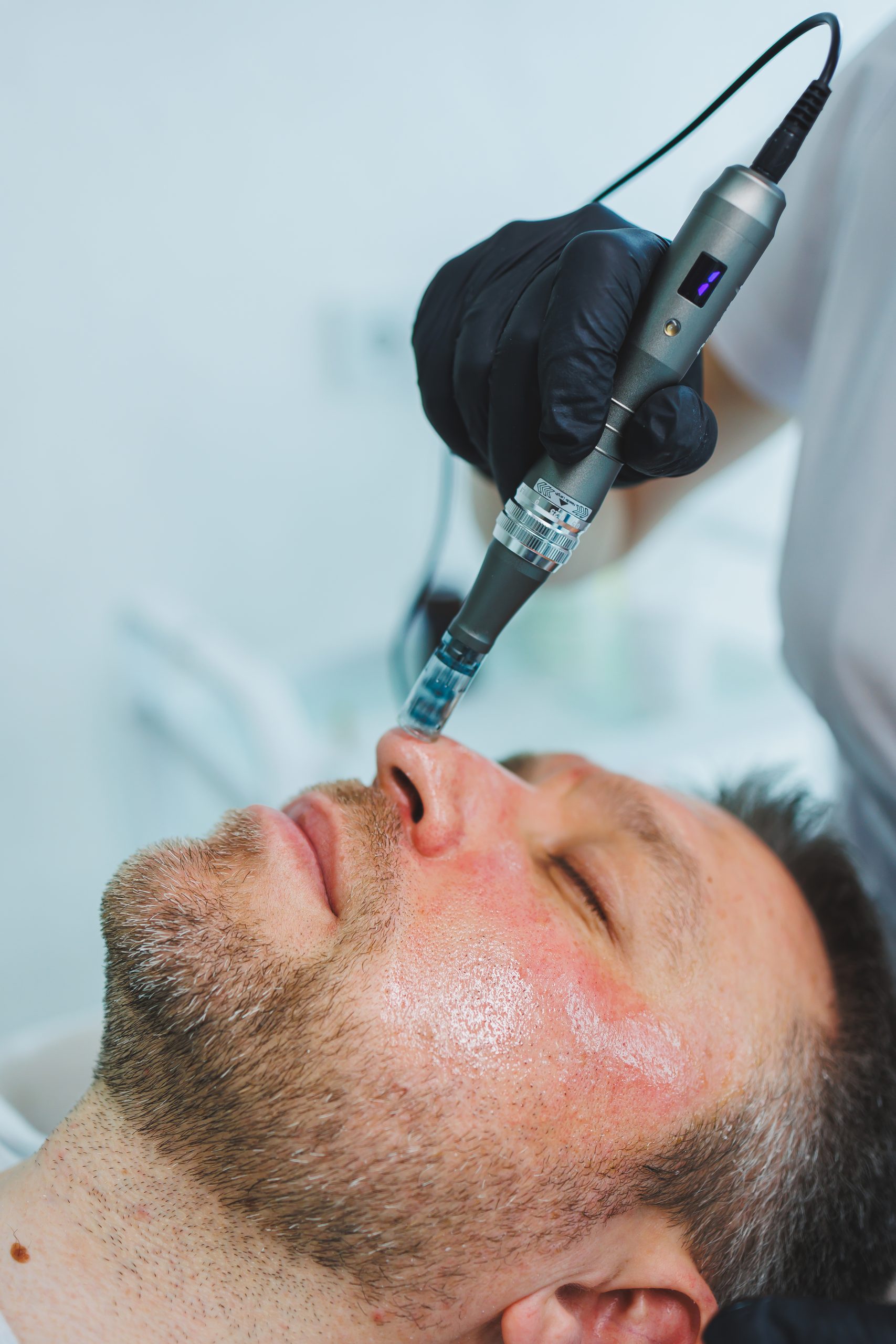 Microneedling+ PRP “Vampire Facial”