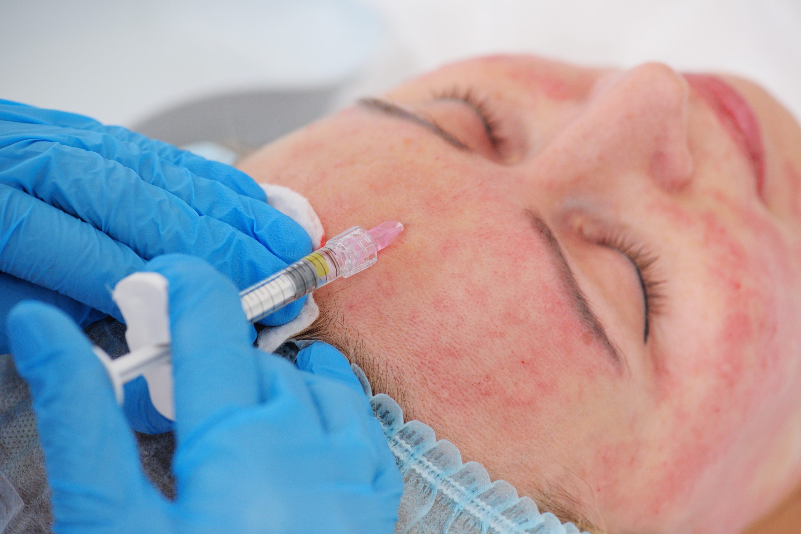 Injections P.R.P. – Visage