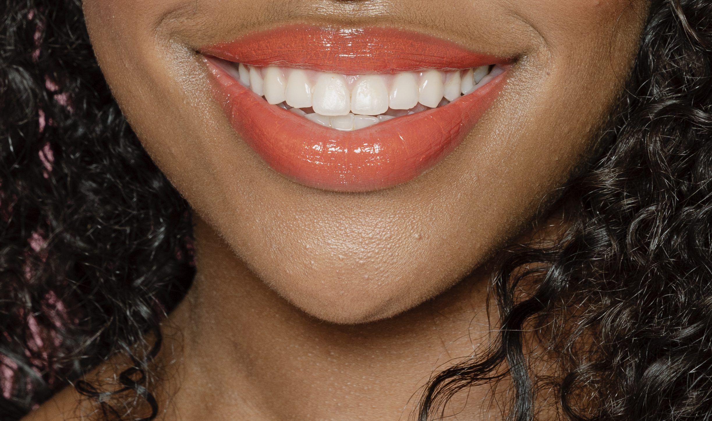 Sourire gingival (Gummy Smile)